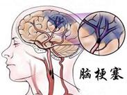 脑梗塞