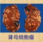 肾母细胞瘤