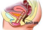 直肠阴道瘘