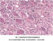 腹膜后肿瘤 腹膜后肿瘤