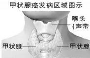 甲状腺癌 甲状腺癌