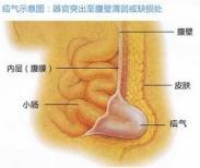 疝气 疝气
