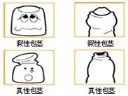 包皮过长