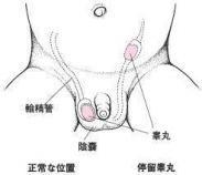 特发性低促性腺激素性性腺功能减退症 特发性低促性腺激素性性腺功能减退症