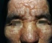原发性系统性淀粉样变 原发性系统性淀粉样变