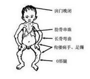营养不良性皮肤钙化病 营养不良性皮肤钙化病