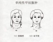 小儿单纯性甲状腺肿 小儿单纯性甲状腺肿