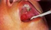 涎腺囊肿