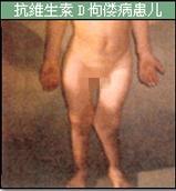 维生素D依赖性佝偻病