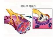吉兰-巴雷综合征