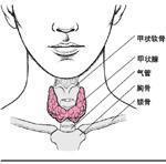 静止性淋巴细胞性甲状腺炎 静止性淋巴细胞性甲状腺炎