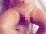 家族性抗维生素D佝偻病 家族性抗维生素D佝偻病