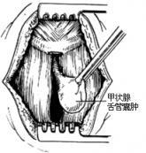 甲状腺舌管囊肿与瘘