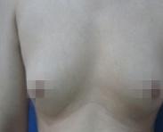 男子乳腺发育