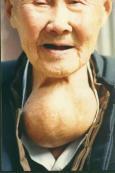 散发性甲状腺肿 散发性甲状腺肿