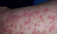 感染性血小板减少性紫癜