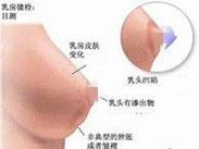 闭经溢乳综合征 闭经溢乳综合征