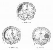 开放性脑外伤