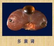 多囊肾