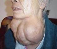 毒性结节性甲状腺肿