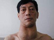 毒性弥漫性甲状腺肿