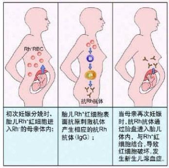 新生儿溶血