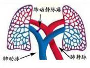 肺动静脉瘘