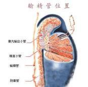 输精管堵塞