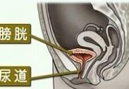 老年女性膀胱颈梗阻 老年女性膀胱颈梗阻