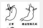 膈肌疾病