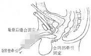 尿道狭窄 尿道狭窄