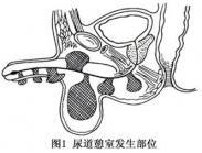 尿道憩室