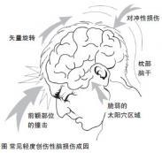 脑震荡