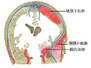 颅内血肿