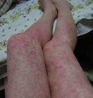 皮肤脑膜瘤