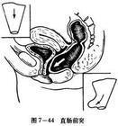 直肠前突