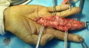 化脓性腱鞘炎 化脓性腱鞘炎