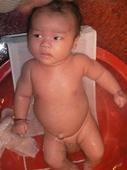 婴幼儿脐疝 婴幼儿脐疝