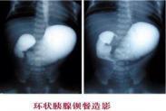 环状胰腺