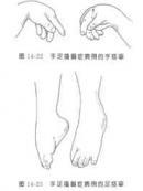 婴儿手足搐搦症 婴儿手足搐搦症