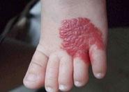 血管瘤