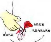 外伤性乳房脂肪坏死