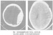 硬脑膜外血肿