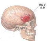 头皮血肿