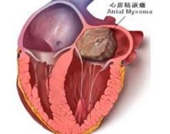 心脏粘液瘤