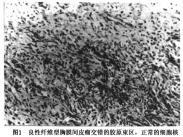 局限性胸膜间皮瘤 局限性胸膜间皮瘤