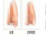 包皮包茎