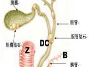 胆管结石 胆管结石