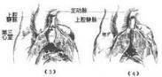 法洛氏四联症