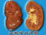 肌病肾病性代谢综合征